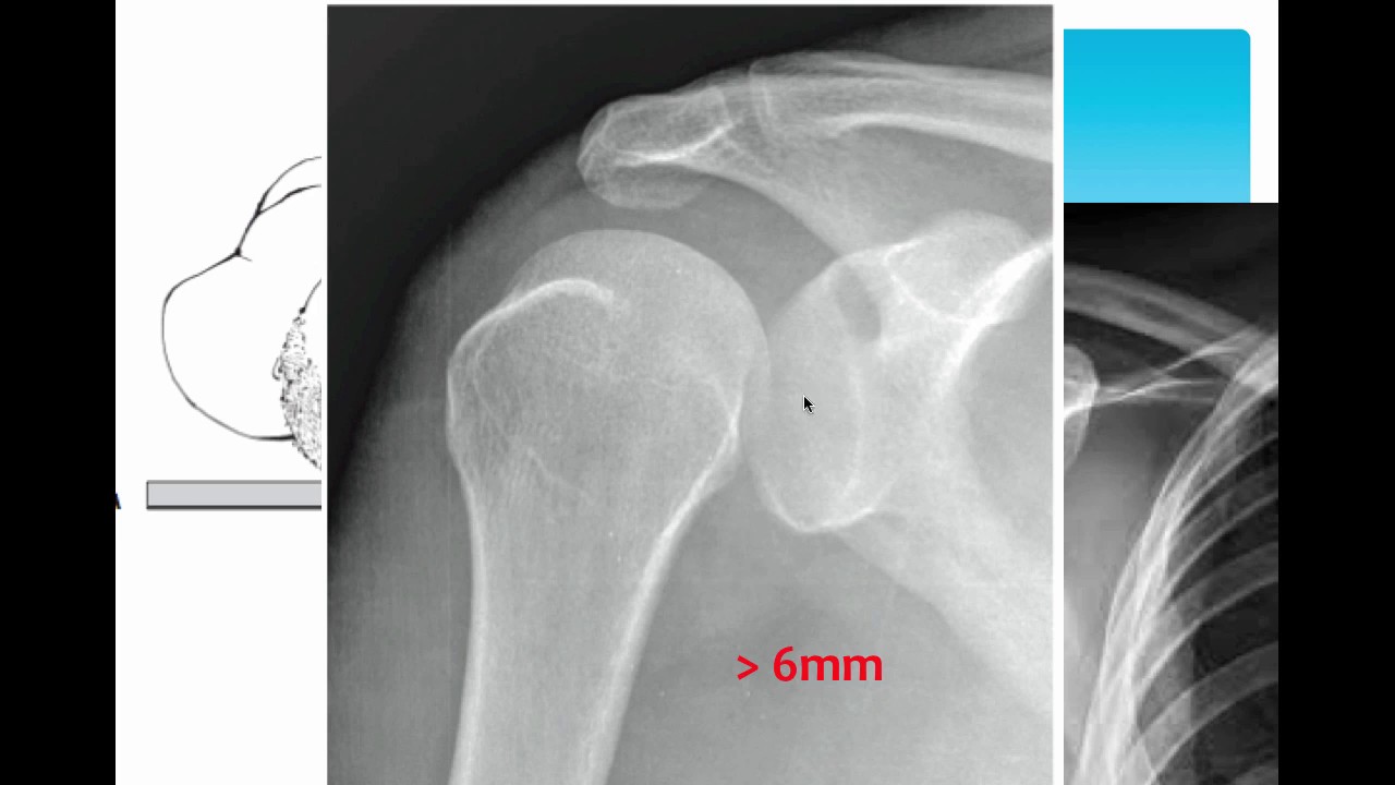 Trật khớp vai - Hình ảnh minh họa